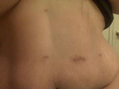 INCISIONS 1 month out