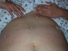 3 small incisions and one larger for the port