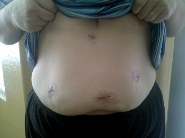 Durring Weight loss