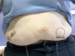 5 days POST OP, whole belly.  Also showing where PORT site is