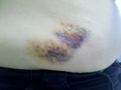 5 days POST OP - Small incision on right...bruised so badly because this is where I recieved my shot of Heprin.  NOT PAINFUL at ALL