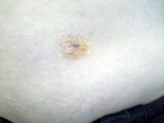 5 days POST OP - Small incision on LEFT