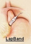 Lap Band illustration