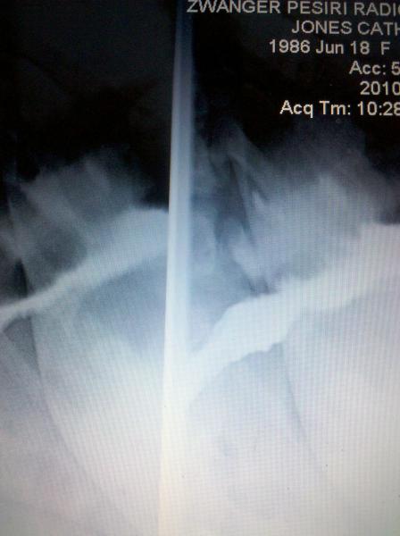 My lapband xray