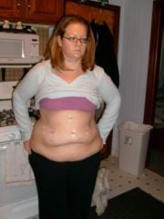 surgery day 5-11-10....day three after surgery, first day home from the hospital, weighing in at 239.5lbs