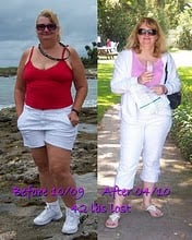 left was taken 6 wks after surgery, the right was 9 mos after