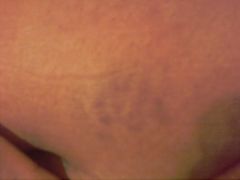 1  Bruising from multiple needle sticksst fill