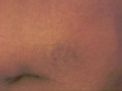 4 Bruising from multiple needle sticks