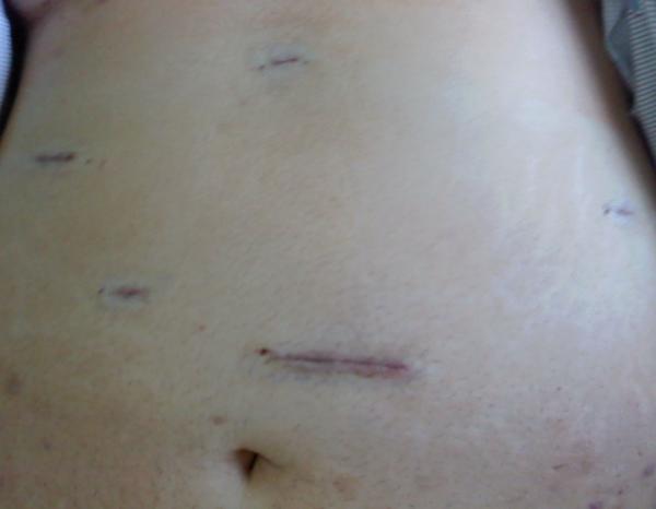 POST-OP