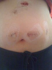 Day Two After Surgery