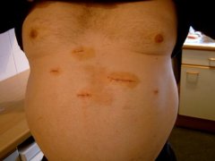 First Operation Scars