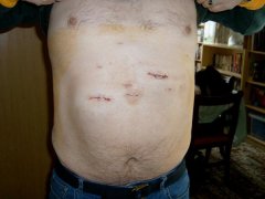 May 2008 - Second Operation Scars