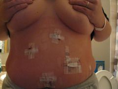 Day 1 - Post op - 222Lbs