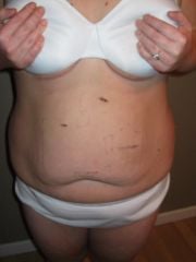Day 12, post-op 215lbs