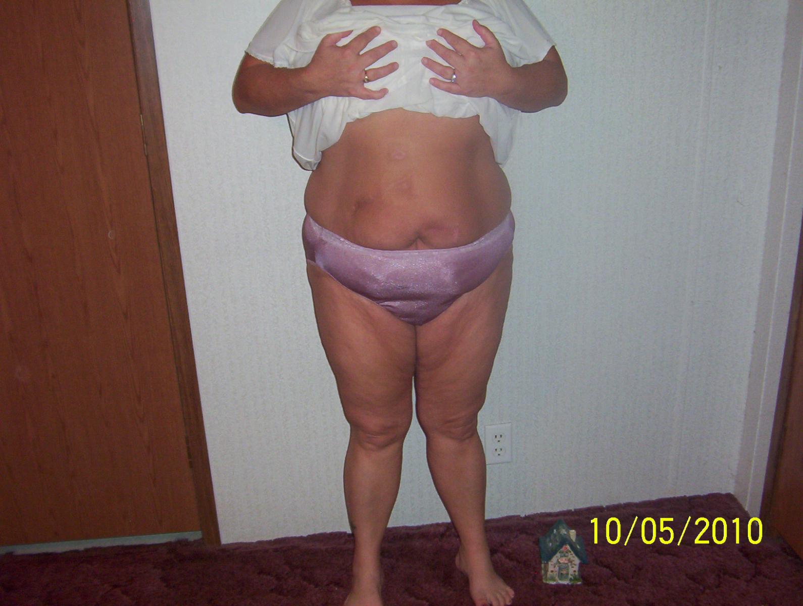 6 months post op 