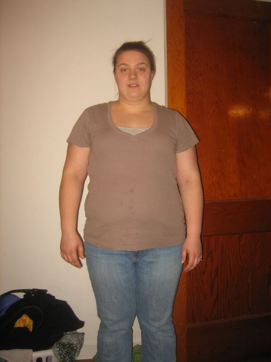 Me now before Surgery
