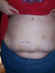Scars 5 days post-surgery