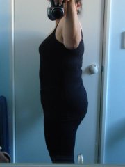 5.5month postop side - 50lbs lost