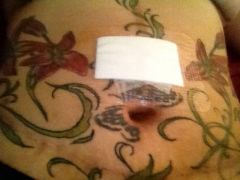 Swollen belly post port replacement
