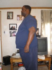post-op 1st. side view month