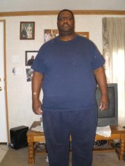 post-op front view 1st month