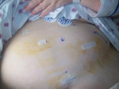 MY TUMMY AFTER SURGERY