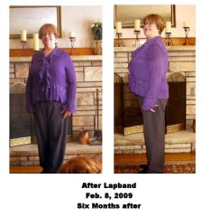 Pati Six months after Surgery
Feb 8, 2009