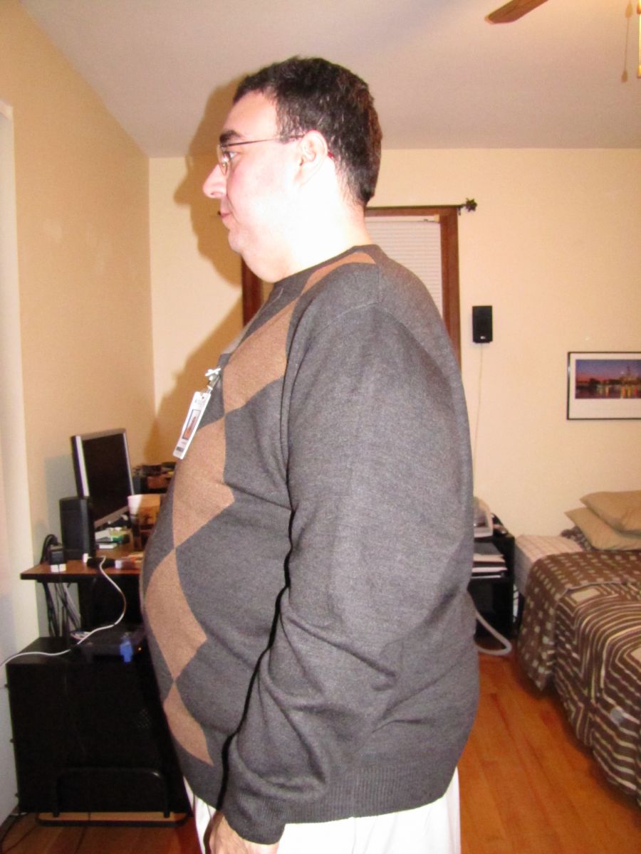 10 Months after Surgery - LapBand