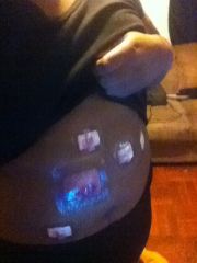 5 incisions