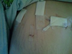 firstsurgscarpic