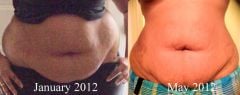 From the day I scheduled surgery, and yesterday, May 6th.