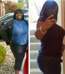 A week after Surgery and a year and four months later!