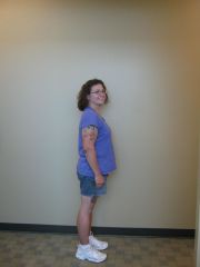 post-op side