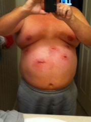 OMG one week post op December 5th 2011