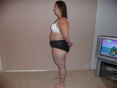 Post LapBand Op   1 Year   07052011 (4)