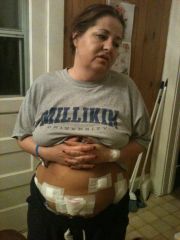 Home after surgery, possibly graphic for some