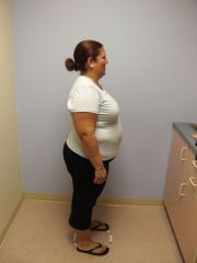 One month before surgery 218lbs