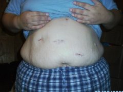 incisions from lapband