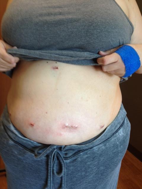 Post surgery