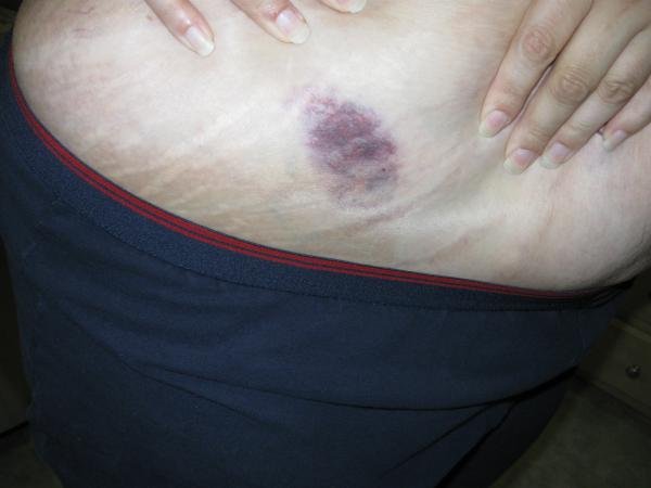 Surgery "war" wounds