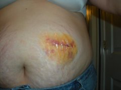 post surgery 92808