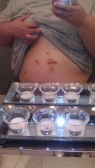 Surgery Scars