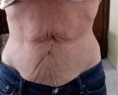 tummy 157 Lbs before