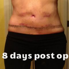 8 days post Op