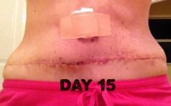Day 15 tummy