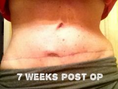 7 weeks post Op