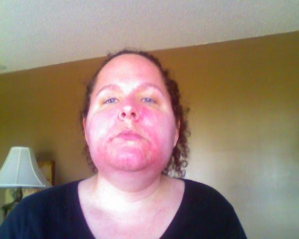 Allergic Reaction