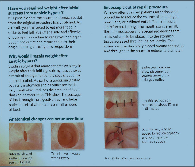 My story… OPEN Roux-en-Y Gastric Bypass Surgery (RNY) in 2002; Revision in 2016