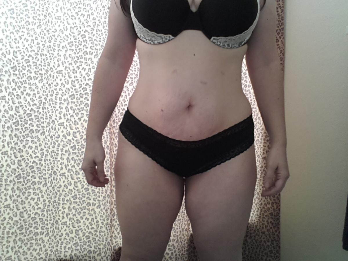 Pics- scars, skin, and stretch marks...OH MY!