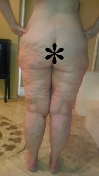 Posterior Body Lift with Auto Augmentation- Anyone have the auto augment done?
